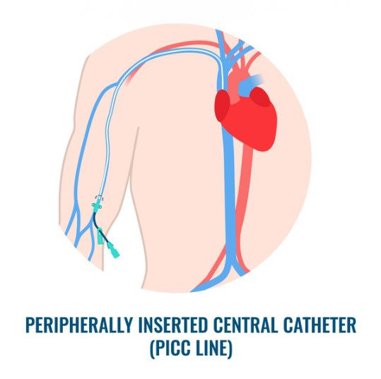 <p><br></p><p style="text-align: left; margin-left:30px;">     <span style="font-size: 20px; color: #b32124; ">         <strong>CHOICE 02.</strong>     </span> </p>  <p style="text-align: left; margin-left:30px;">     <span style="font-size: 28px; color: #363636;"><strong>PICC</strong></span></p>