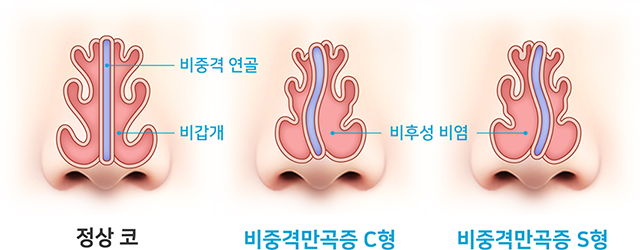 송산두리이비인후과 비중격만곡증 수술