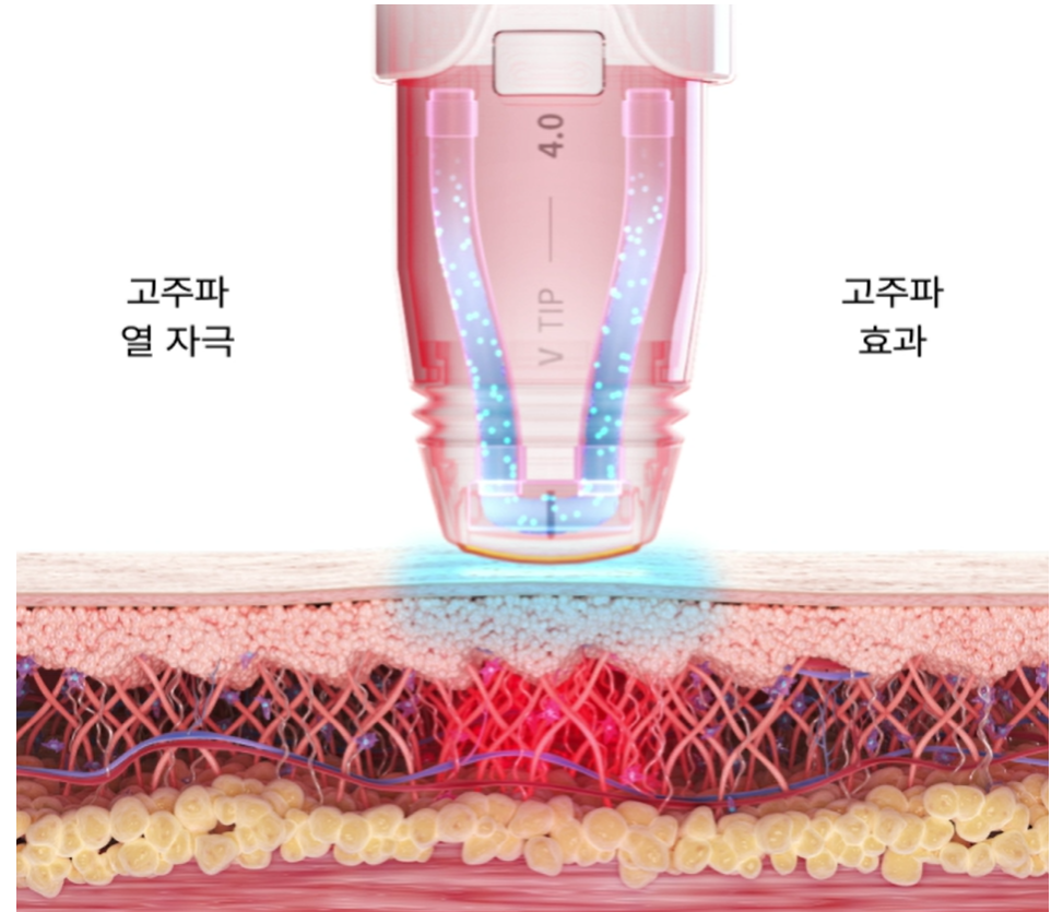 볼뉴머 리프팅장비의 고주파에너지와 쿨링기전 원주피부과 원더스의원