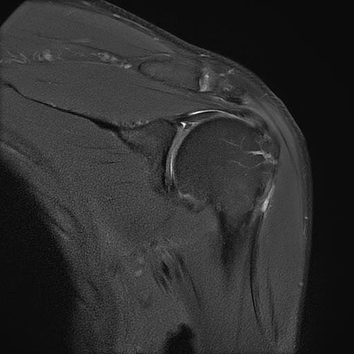 관절순파열 MRI
