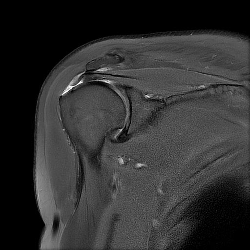 회전근개파열 MRI