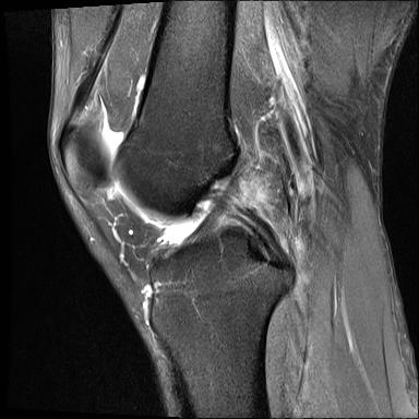 후방 십자인대파열 MRI