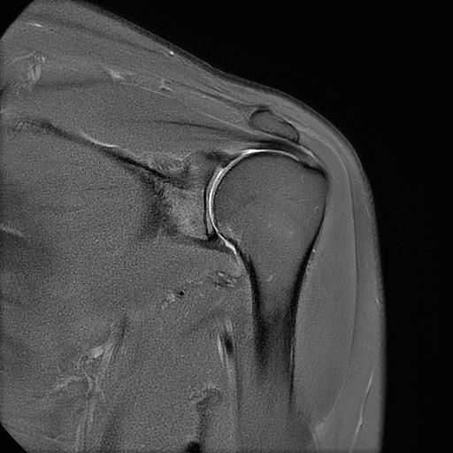 오십견 MRI