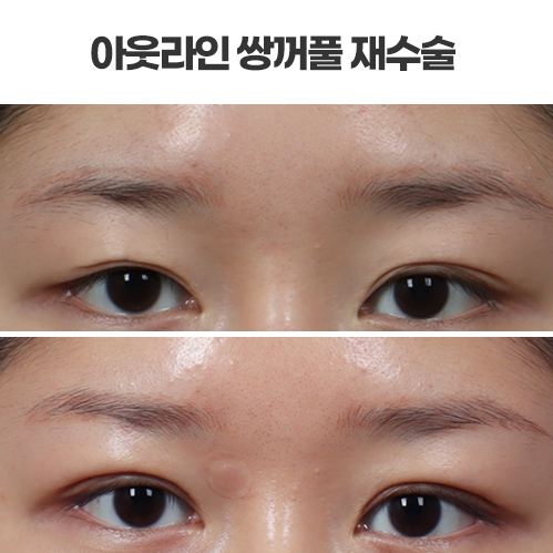 수술 일기 13) 쌍꺼풀 재수술, 절개 아웃라인ㆍ쌍꺼풀선 풀림 : 대구 리프트성형외과ㅣ눈성형ㅣ쌍꺼풀수술