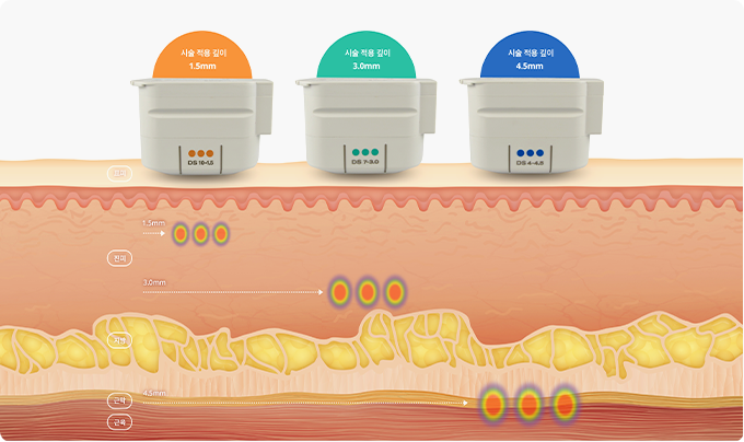 울쎄라리프팅의 전용팁 별로 시술 적용 깊이를 표현한 이미지입니다. 상단에 3개의 팁들이 있으며 주황, 청록, 파란색으로 표현되어 있습니다. 주황색은 1.5mm, 민트색은 3.0mm, 파란색은 4.5mm의 시술 적용 깊이를 가지고 있습니다.