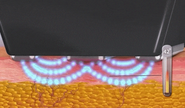 인모드 Forma가 콜라겐생성을 촉진시키고 있는 모습입니다.