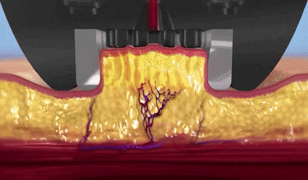 인모드 리프팅 미니FX가 지방세포를 사멸하고 있는 모습입니다.