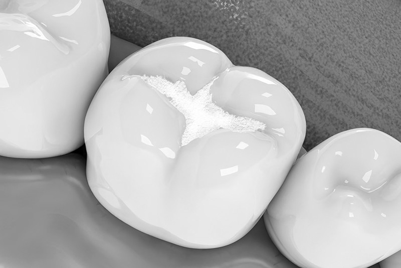 부천-연세미소애치과-실란트치료