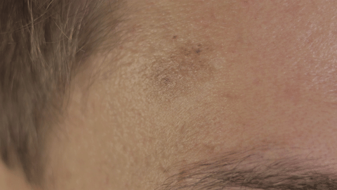 오른쪽 눈썹 위에 위치한 흑자를 확대한 이미지입니다. 이미지의 사람은 흑자를 손가락으로 가리키는 모습을 하고 있습니다.