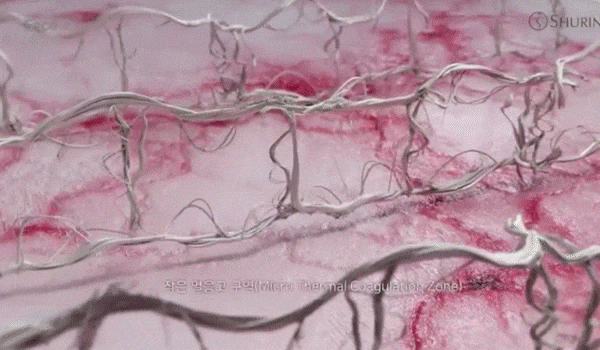 피부조직을 확대한 이미지입니다. 넝쿨처럼 생긴 조직들이 레이저를 맞고 조여지는 모습입니다. 