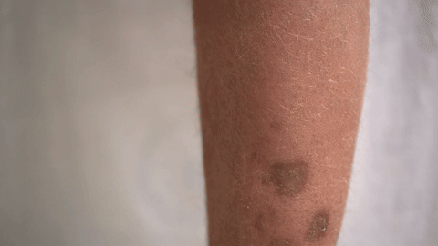 한쪽 팔에 난치성 색소질환을 가지고 있는 사람의 팔입니다. 검은 자국들이 팔 곳곳에 위치하고 있습니다.