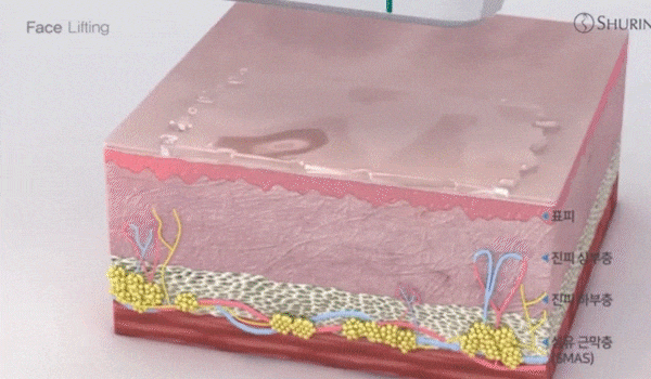 각 팁 별로 피부층에 몇 mm까지 침투할 수 있는지 보여주고 있습니다. 1.5, 3.0, 4.5mm까지 3가지 전용팁들을 보여주고 있습니다.