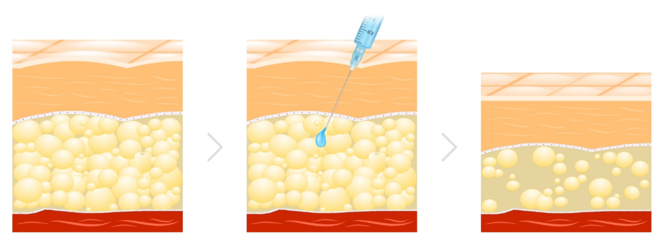 바디조각주사의 효과를 설명하는 그림 원주피부과 원더스의원