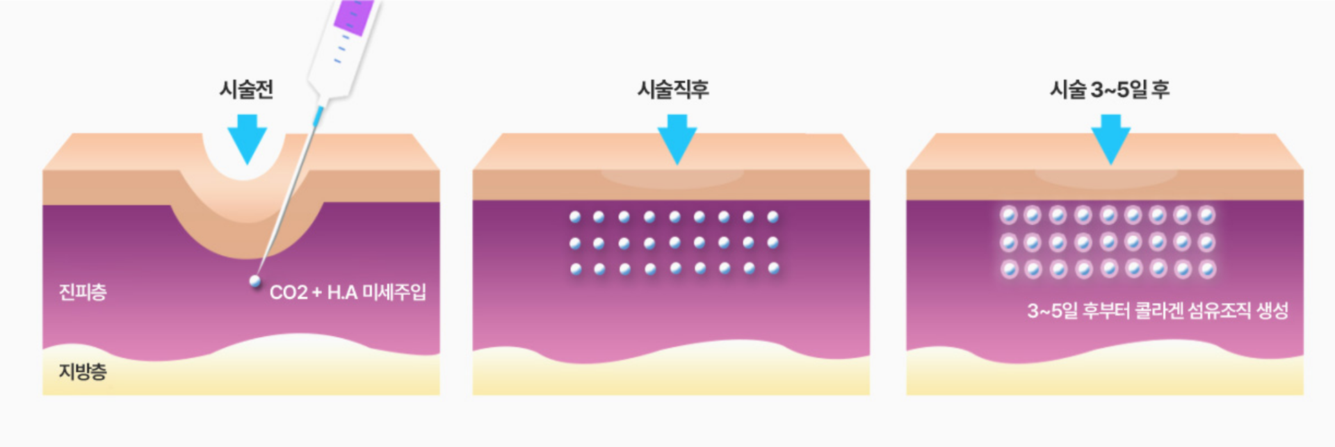 이산화탄소와 히알루론산 교차주사로 깊은주름과 패인흉터에 효과를 내는 쥬브젠시술 원주피부과 원더스의원