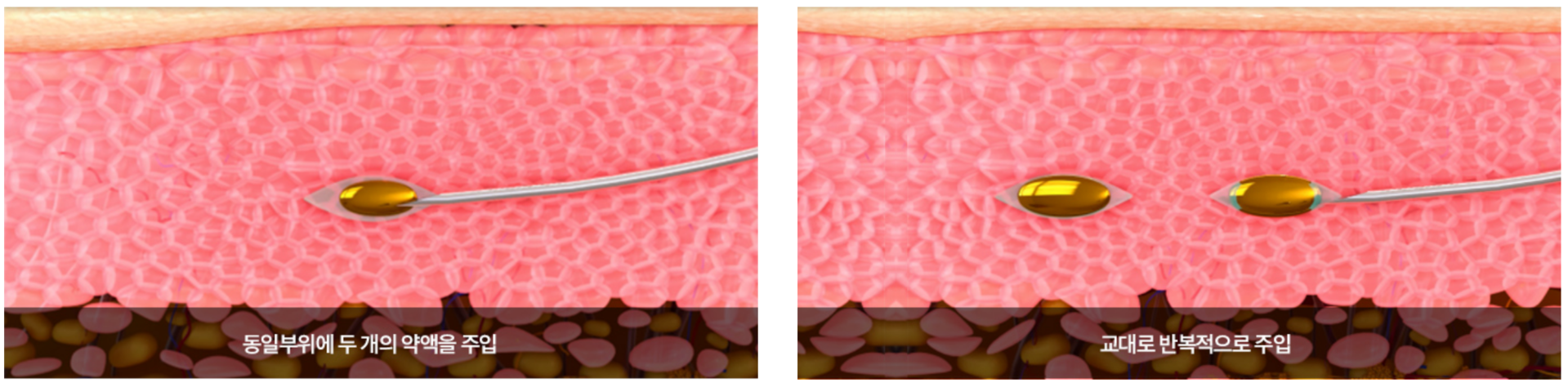 쥬브젠 시술이 깊은 주름과 흉터에 효과가 있는 기전 원주피부과 원더스의원