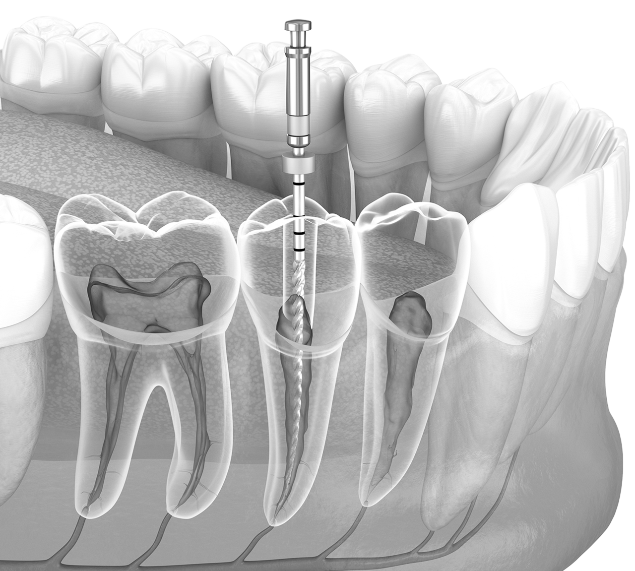 오정구-삼정동-연세미소애치과-신경치료-자가진단