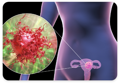 <alt=자궁경부암>