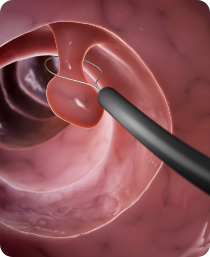 <alt=당일용종절제>