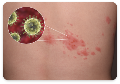 <alt=대상포진>