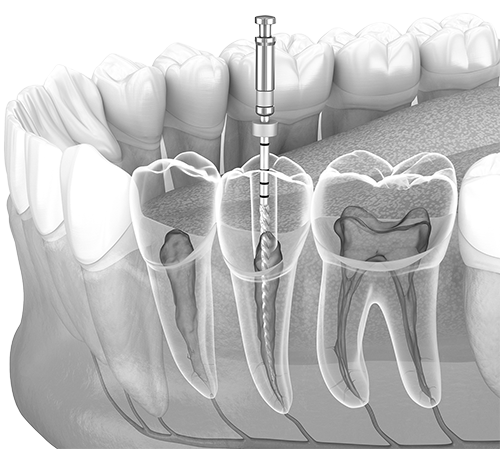 오정구-삼정동-연세미소애치과-신경치료-자가진단
