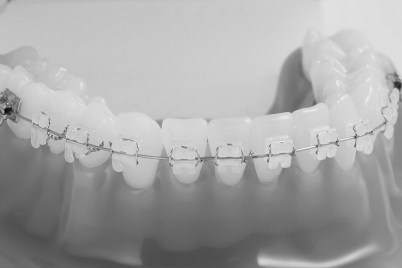 오정구-삼정동-연세미소애치과-교정치료-전제교정