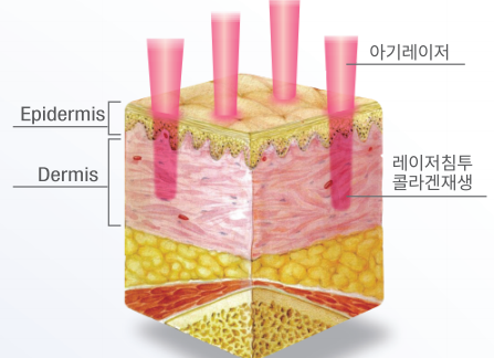 아기레이저 디오레듀얼의 레이저 그래픽 모형 원주원더스피부과