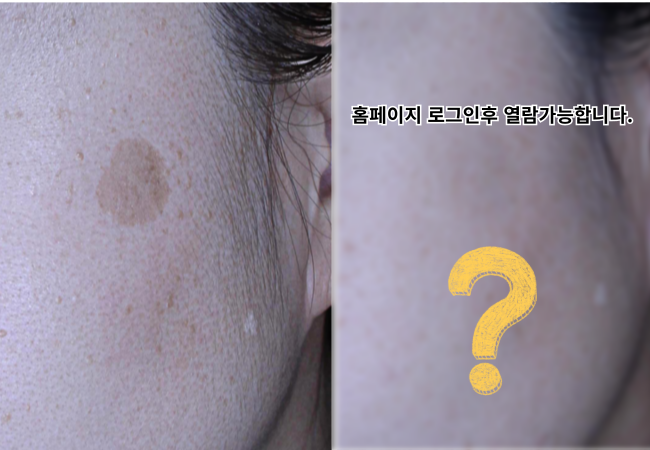 흑자 원주피부과 원더스의원 레이저치료 전후사진 리팟레이저 없이도 가능한 흑자제거