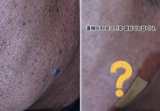 검버섯 원주피부과 원더스의원 레이저치료 전후사진