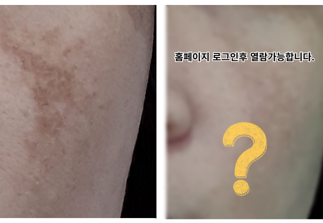 기미치료 원주피부과 원더스의원 레이저치료 전후사진