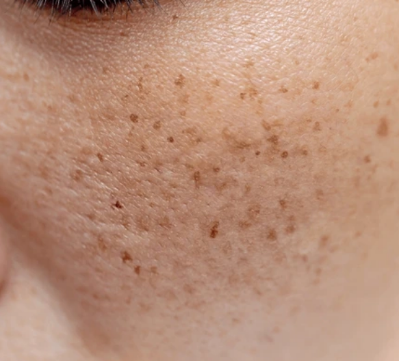 기미 잡티 색소레이저 치료 원주피부과 원더스의원