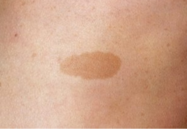 밀크커피반점 원주피부과 원더스의원 레이저치료