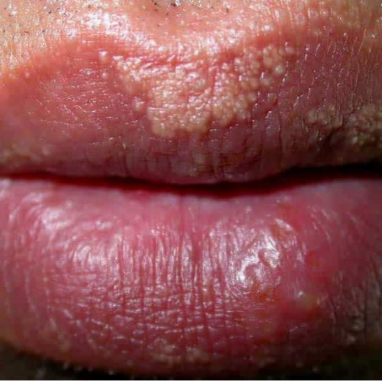 입술에 생기는 이소성 피지선증식증인 포다이스반 병변입니다. 원더스의원의 아그네스 치료를 권해드립니다.