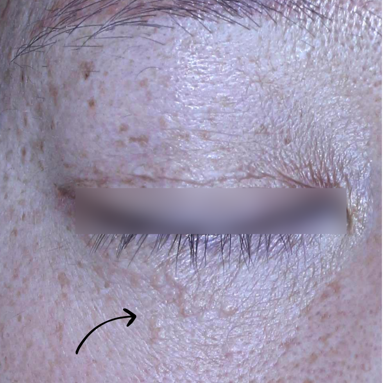 아그네스 치료가 필요한 눈주변, 이마, 볼 등의 한관종 병변 사진입니다.