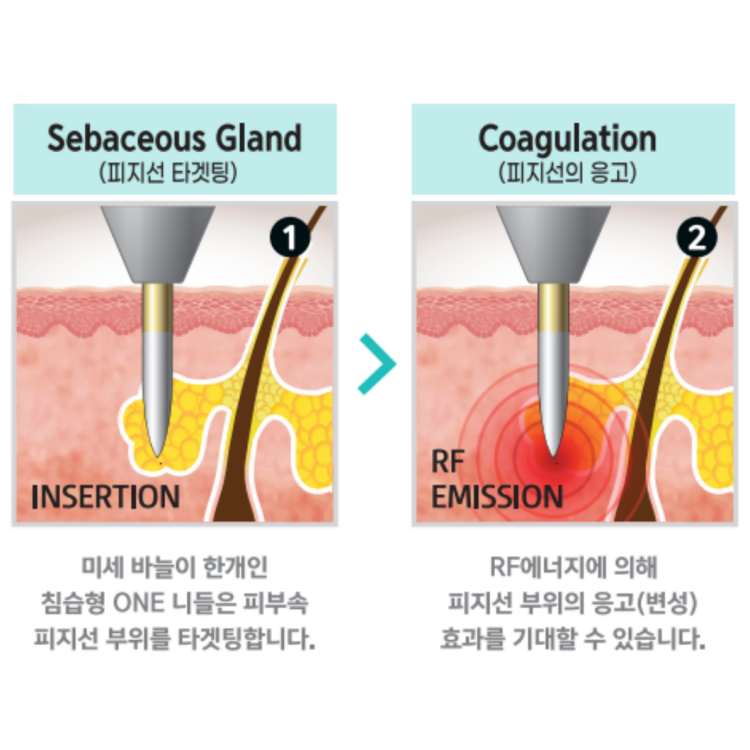 니들고주파는 피지선에 직접 고주파에너지를 전달하여 피지선, 한관종을 선택적으로 파괴합니다. 그렇기 때문에 여드름치료와 피지선증식증, 한관종 제거에 효과적입니다. 원주피부과 원더스의원