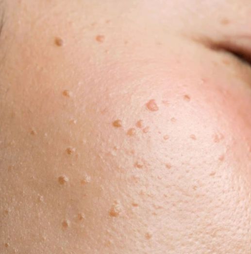 눈옆의 비립종과 편평사마귀가 있는 환자의 사진입니다. 사마귀는 바이러스에 의해 생기는 병변으로 오돌토돌한 연갈색 병변이 시간이 지날수록 커지고 많아지기 때문에 조기제거가 필요합니다.  원주피부과 원더스의원