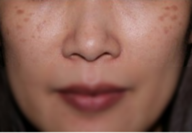 오타양모반 원주피부과 원더스의원 레이저치료