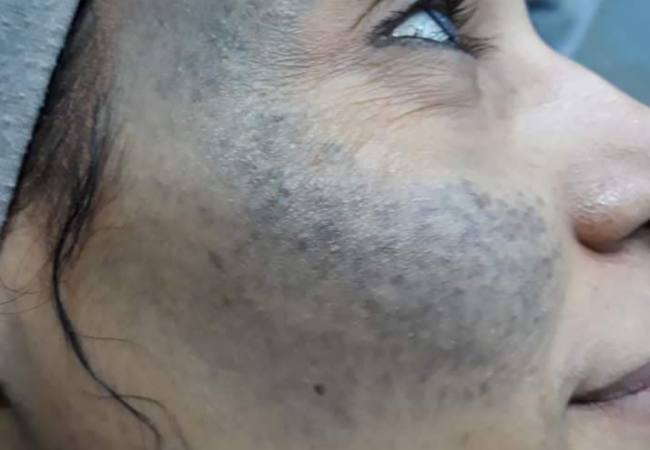 오타모반 원주피부과 원더스의원 레이저치료