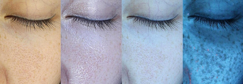 원주 원더스의원의 피부진단기 마크뷰는 네가지 광원으로 피부를 촬영하여 표피부터 진피까지 눈으로 보이지 않는 곳까지 자세히 진단하여 맞춤형 치료계획 수립가능합니다. 시술전후 효과를 객관적으로 비교해드리며 시각적으로 피부상태를 자세히 설명해드려요