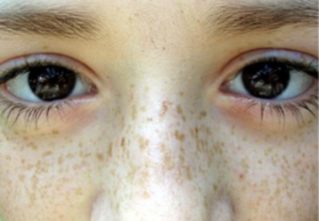 주근깨 원주피부과 원더스의원 레이저치료