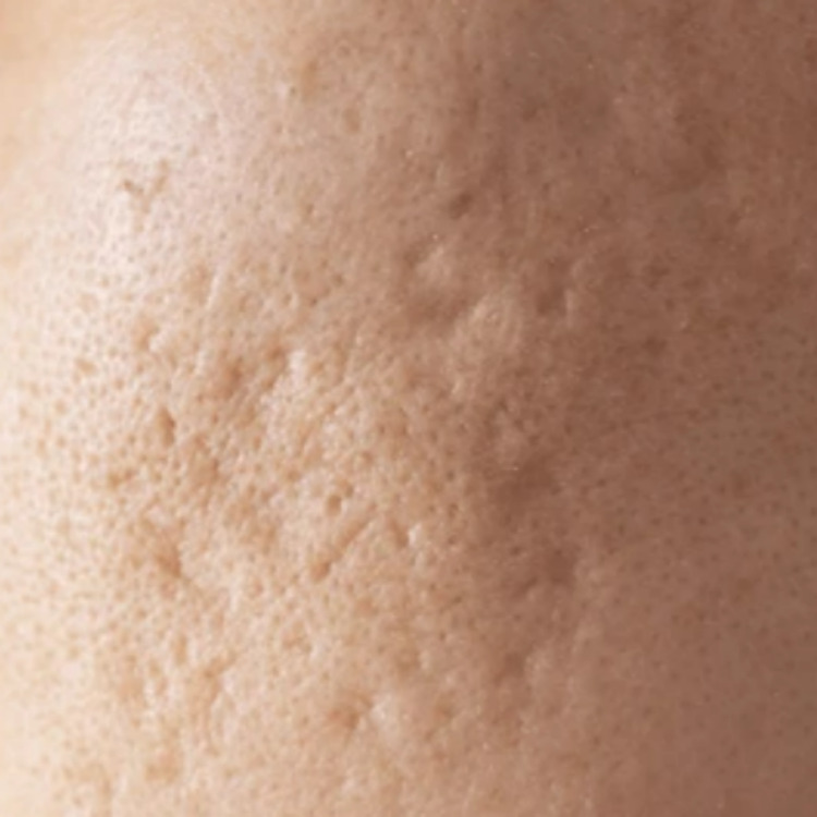 패인흉터 함몰흉터 클로즈업 원주원더스피부과