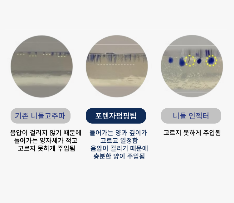 포텐자 펌핑팁은 스킨부스터가 주입되는 양과 깊이가 고르고 일정합니다. 음압이 걸리기 때문에 기존니들고주파 보다 충분한 양이 주입되며 압력 차에 따라 고르지 못할 수 있는 니들인젝터보다 통증이 적고 안전합니다.  원주원더스피부과