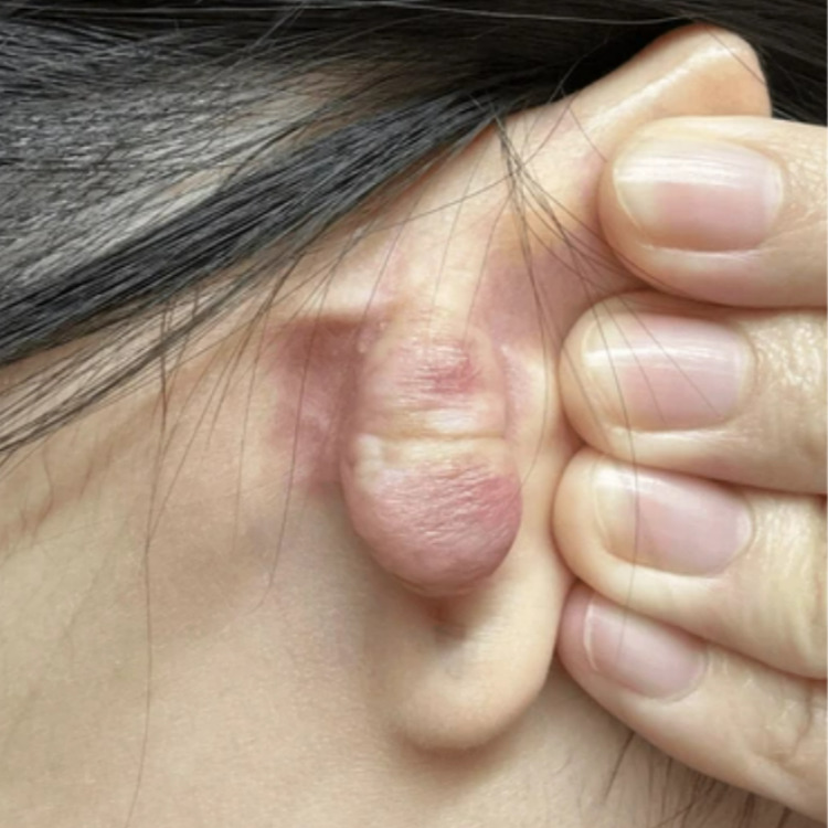 귀에 발생한 켈로이드흉터 클로즈업 원주원더스피부과