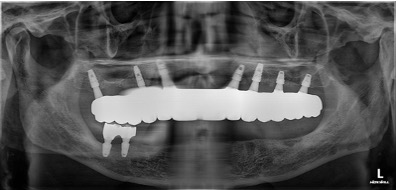2024.02.29 최종 보철