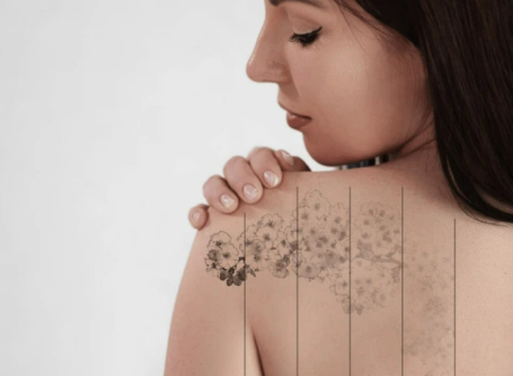 문신제거 레이저의 치료효과 사진 원주 원더스 피부과