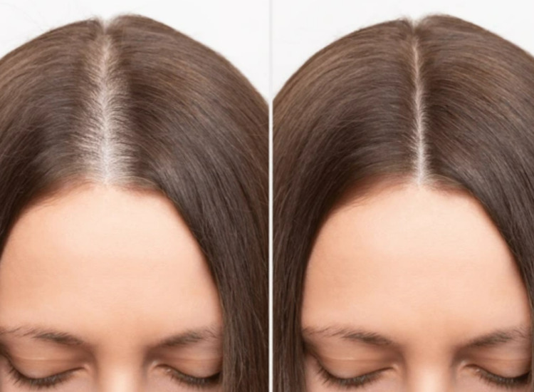 모낭주사의 효과 탈모치료 전후 비교사진모형 원주피부과 원더스의원 탈모치료