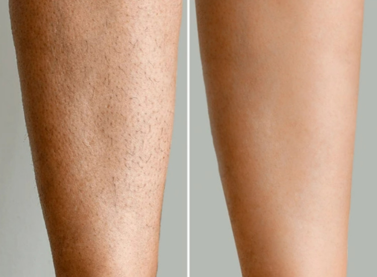원주 원더스 피부과  종아리제모효과