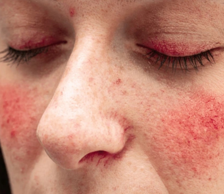 얼굴전체, 특히 볼에 안면홍조, 주사가 심한 여성의 얼굴사진입니다.