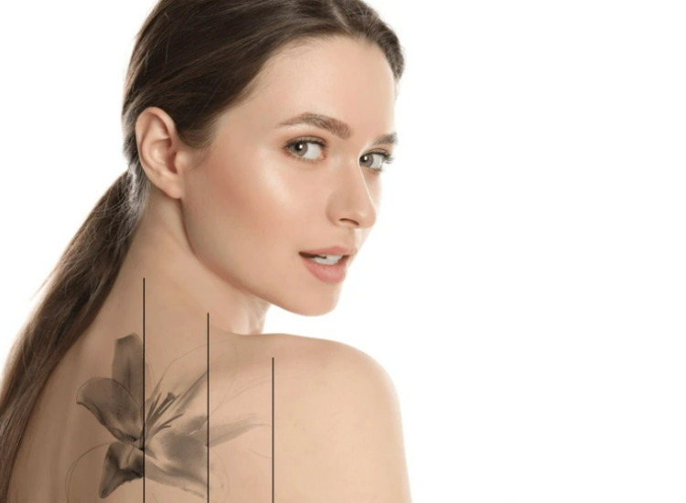 문신제거의 치료효과 깨끗한 피부 사진 원주 원더스 피부과