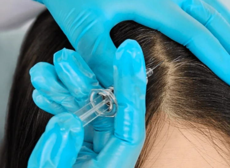 모낭주사 시술장면 원주피부과 원더스의원 탈모치료