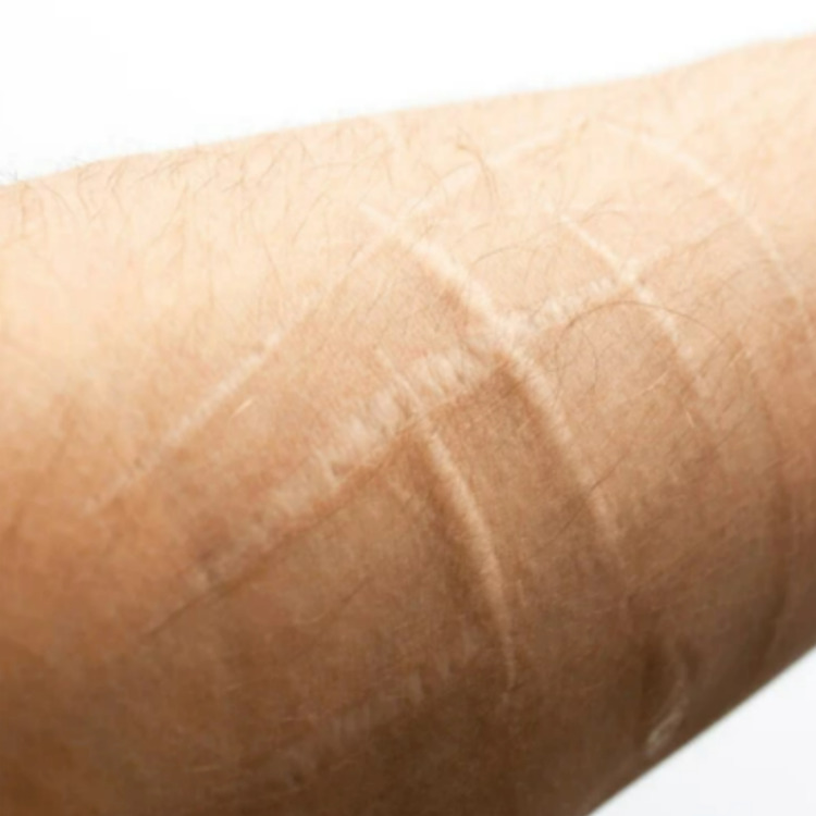 자해흔, 일자흉터 클로즈업 원주원더스피부과